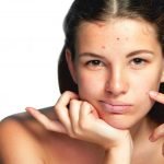 Bava di Lumaca per acne: funziona davvero?