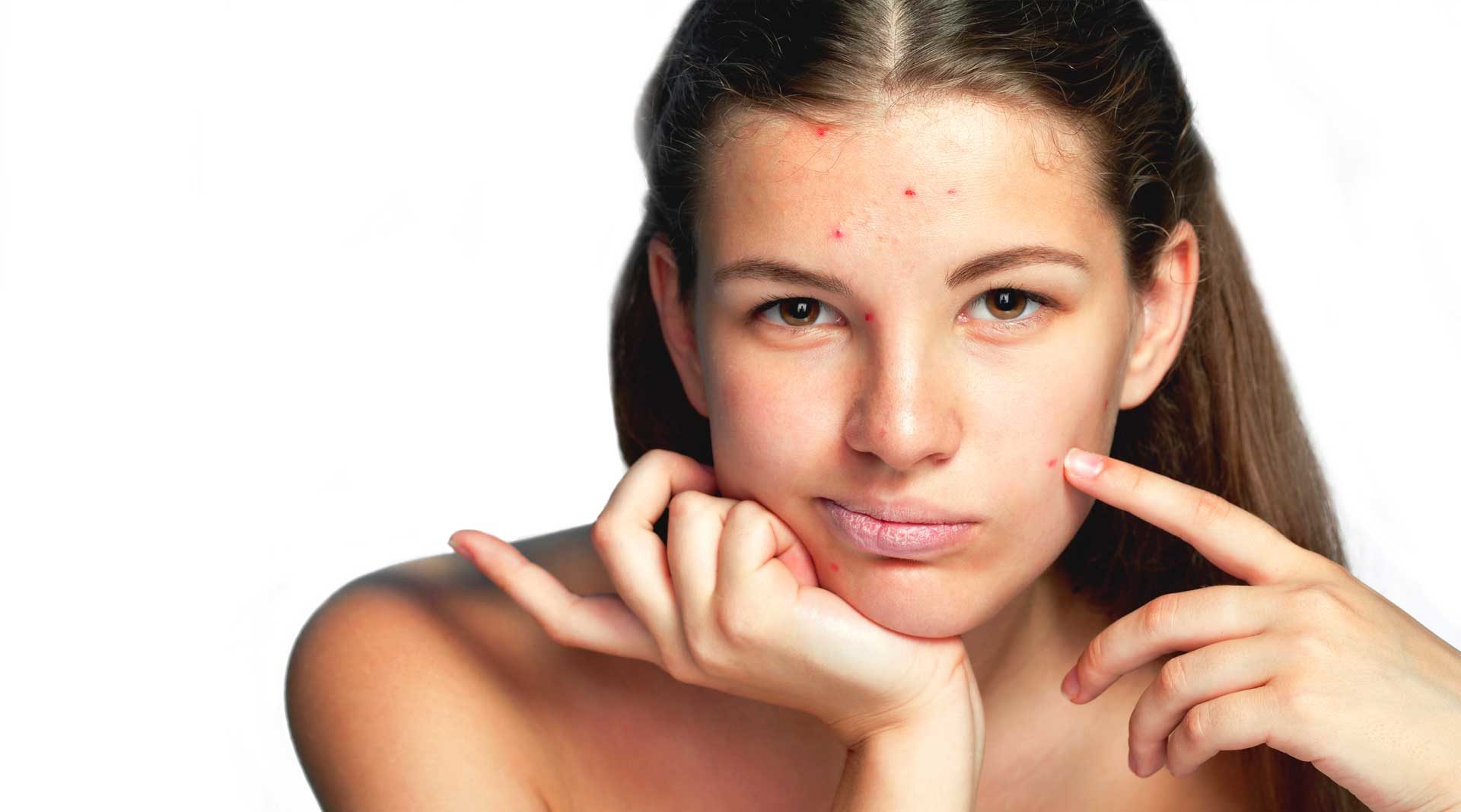 Al momento stai visualizzando Bava di Lumaca per acne: funziona davvero?